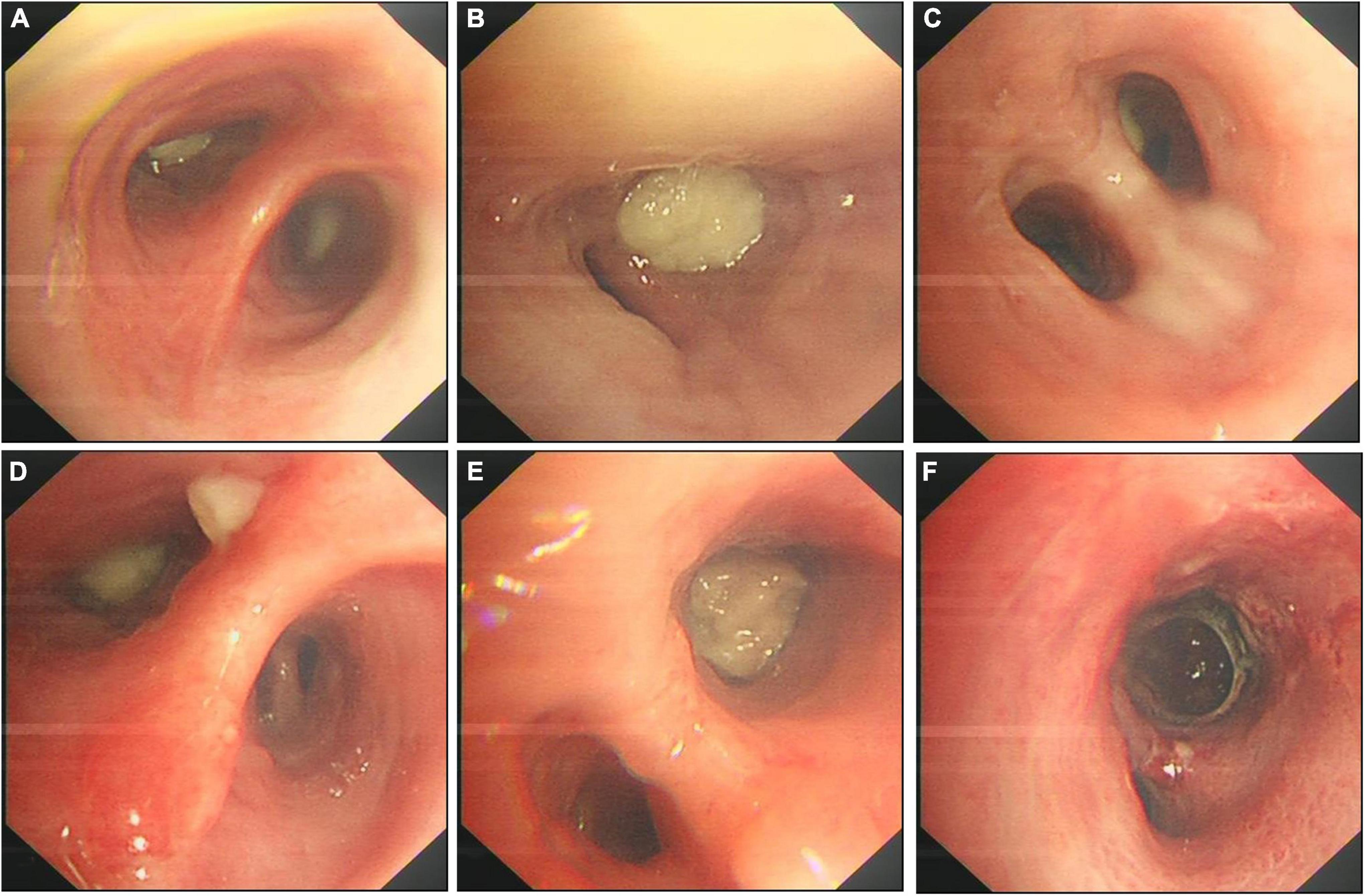 Actinomyces bacteria oral