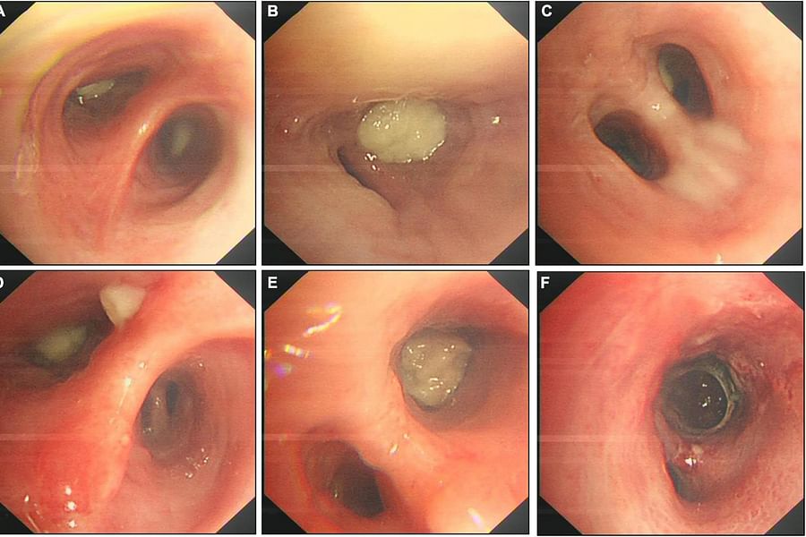 Actinomyces bacteria oral