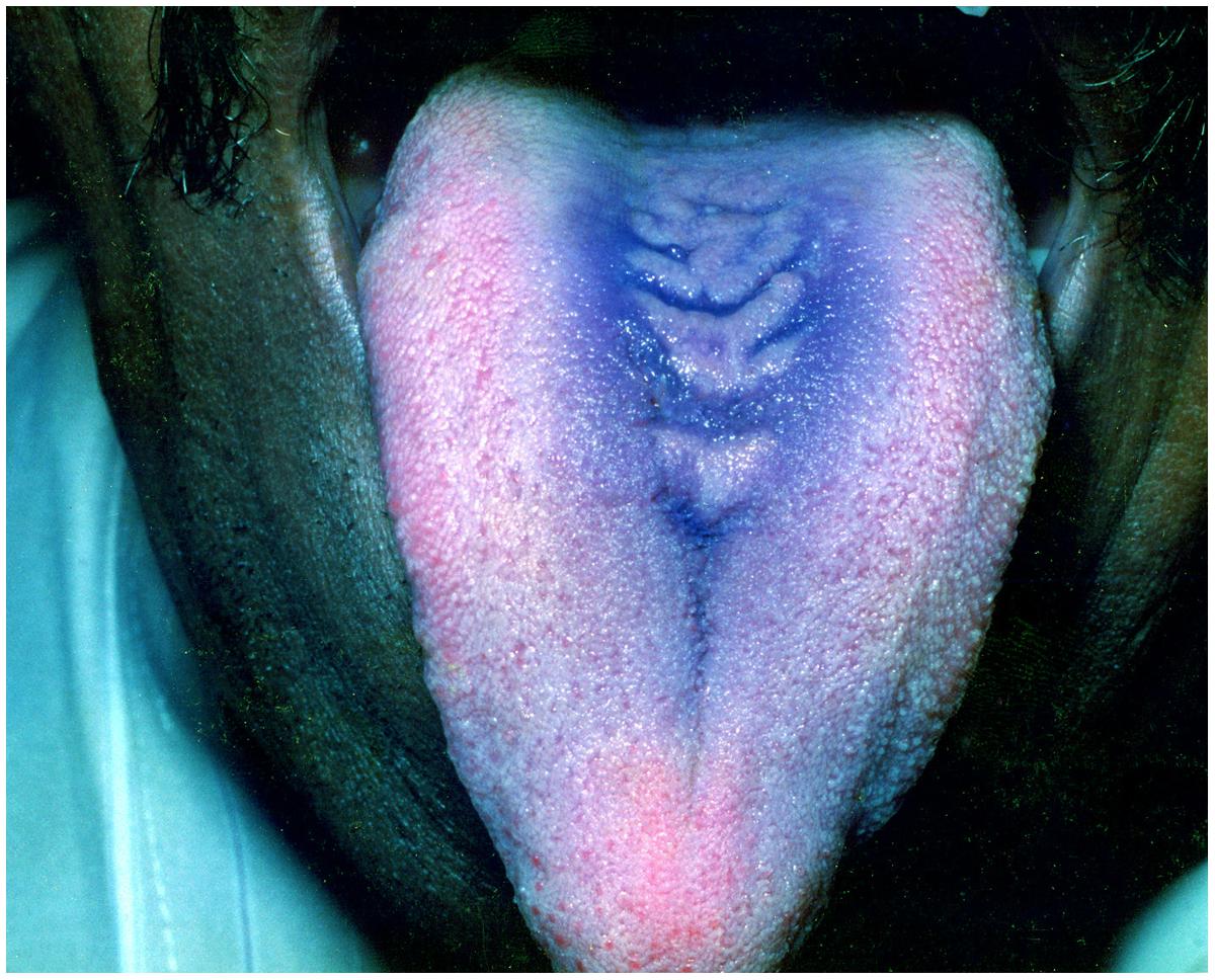 phage therapy mouthwash