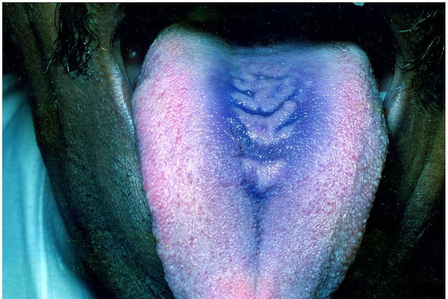 phage therapy mouthwash