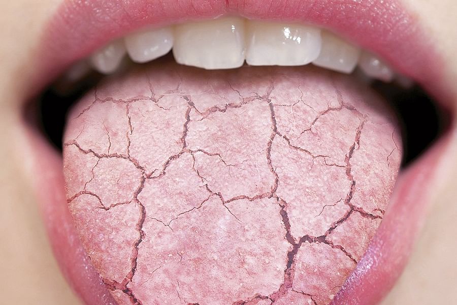 synthetic saliva for dry mouth