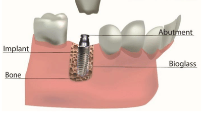 Dental Implant Technology: The Latest Advancements and Benefits