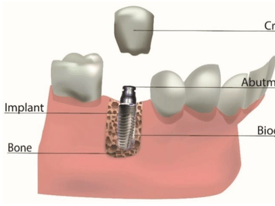 Dental Implant Technology: The Latest Advancements and Benefits