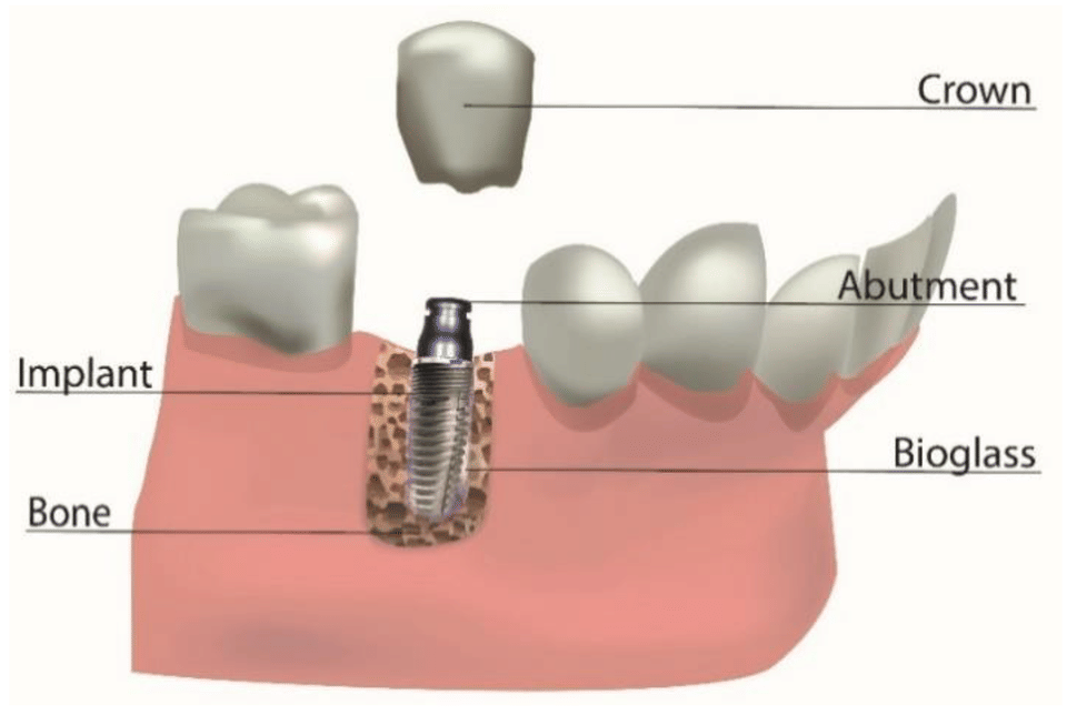 Dental Implant Technology: The Latest Advancements and Benefits